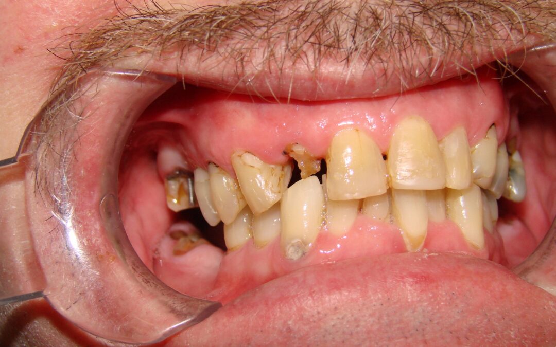 mouth requiring upper dental implants from our dental clinic in barrie