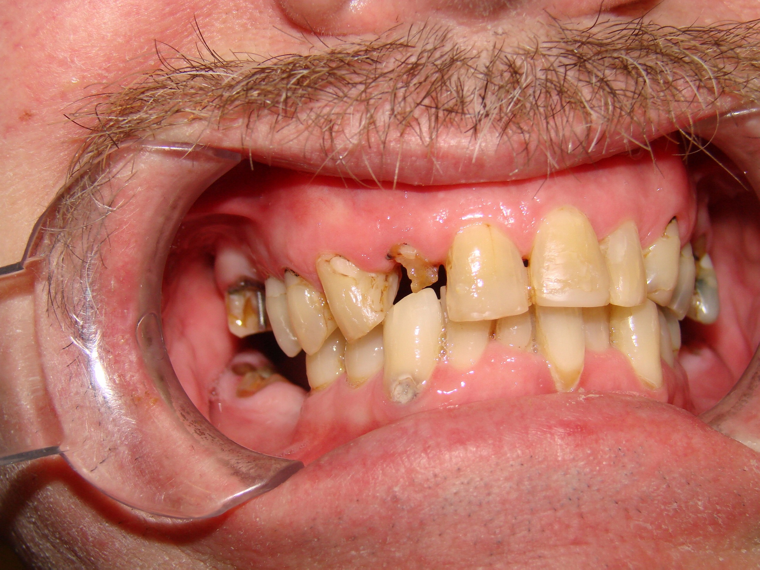 mouth requiring upper dental implants from our dental clinic in barrie