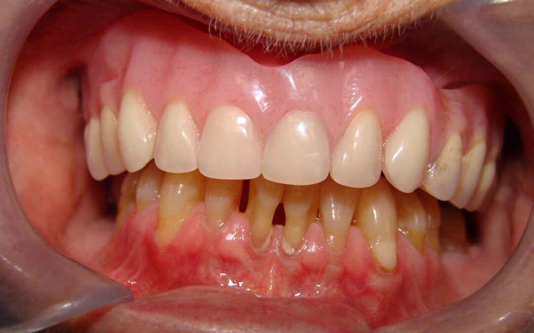 patient requiring lower dental implants in Barrie
