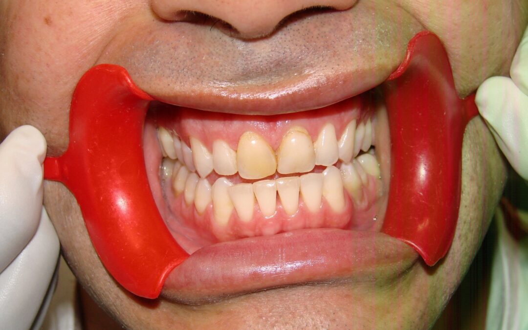 before teeth whitening and veneers from our dental clinic in Barrie