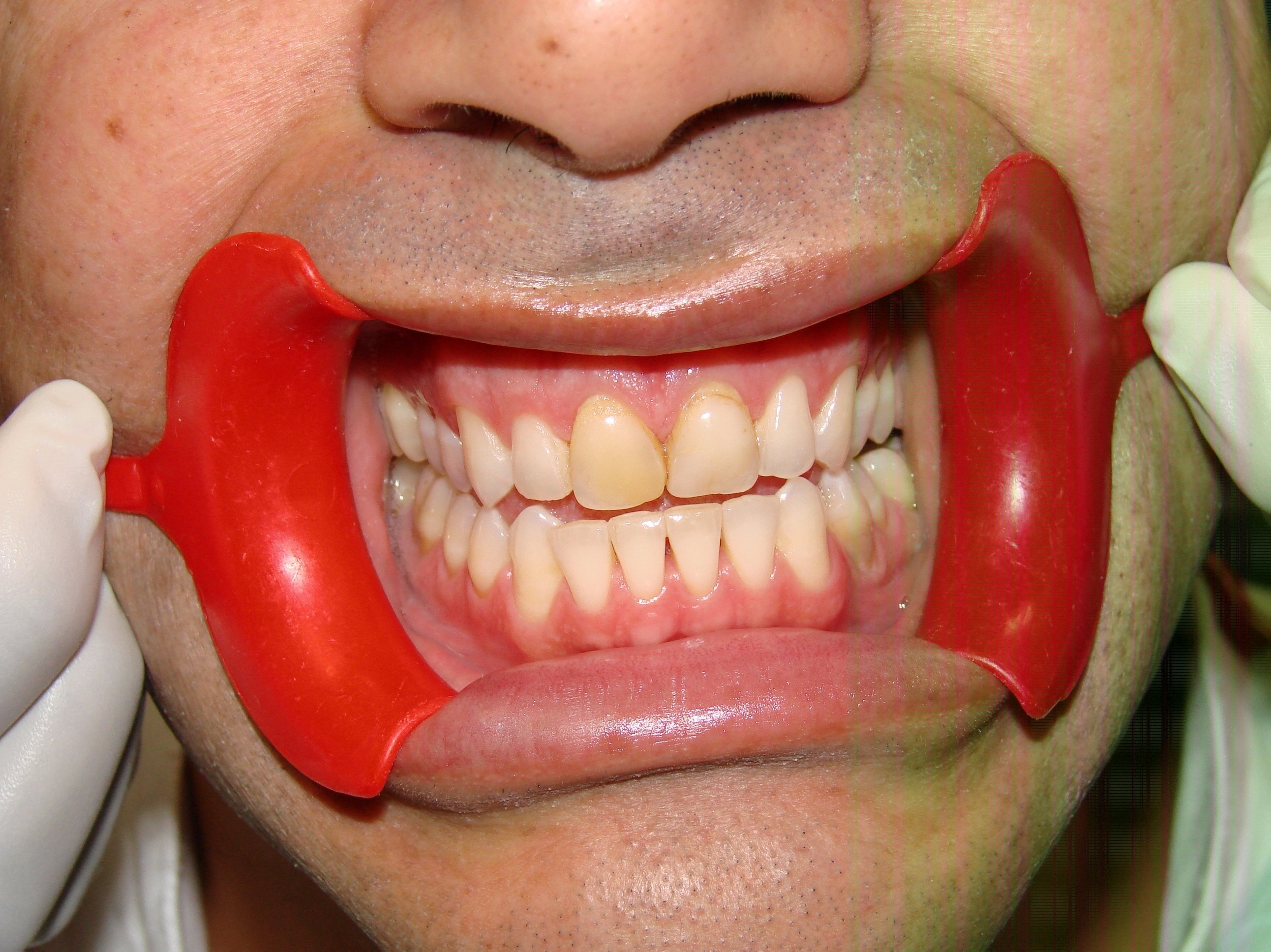 before teeth whitening and veneers from our dental clinic in Barrie