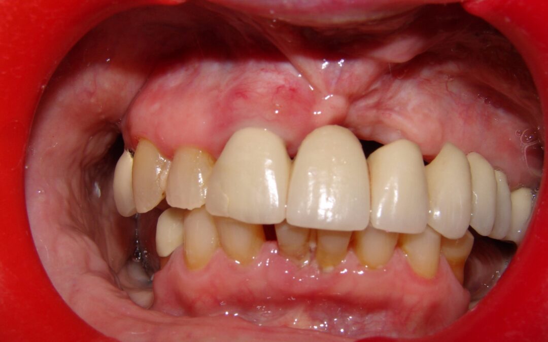before dental prosthetic and implants from our dental clinic in Barrie