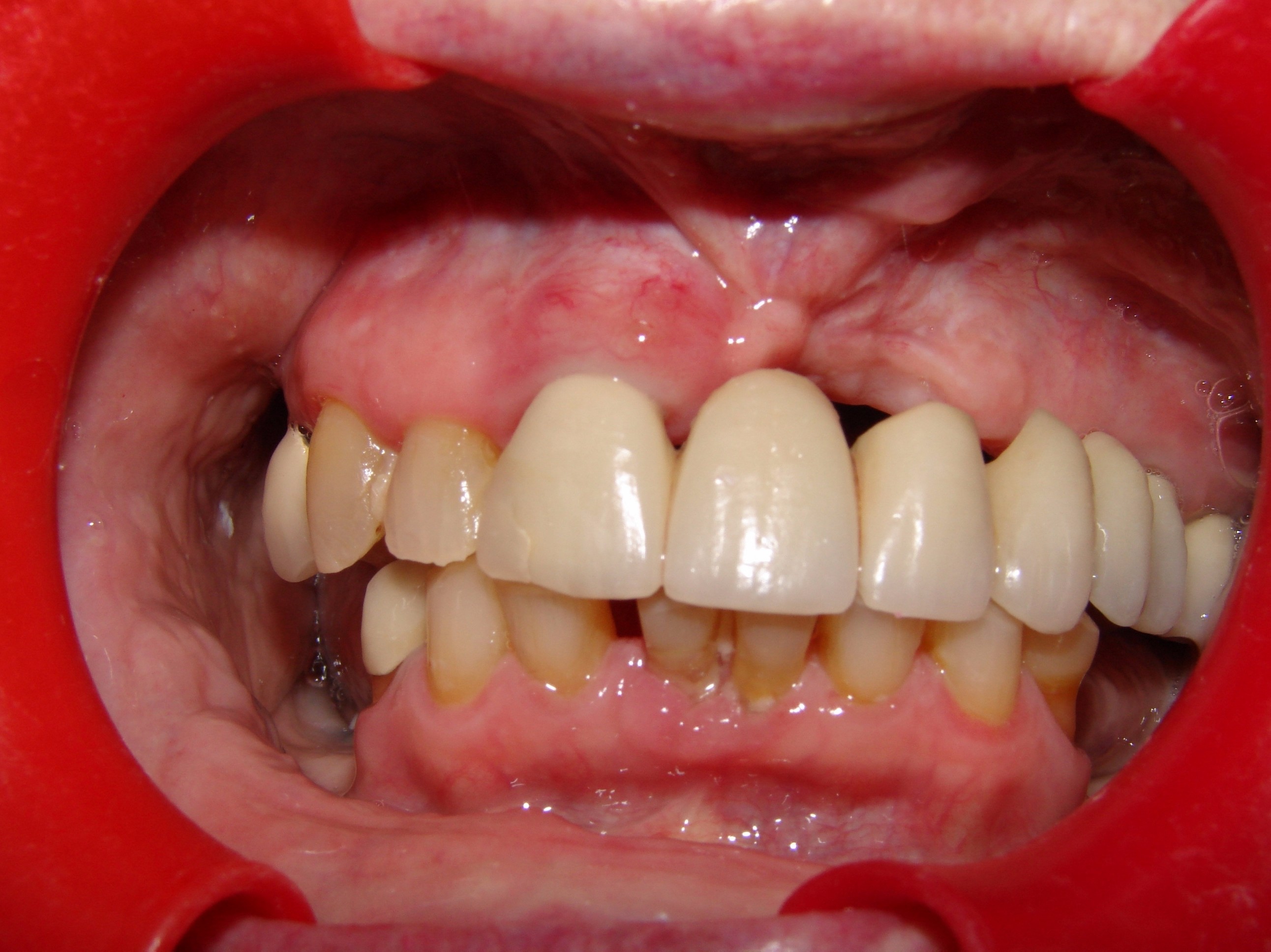 before dental prosthetic and implants from our dental clinic in Barrie