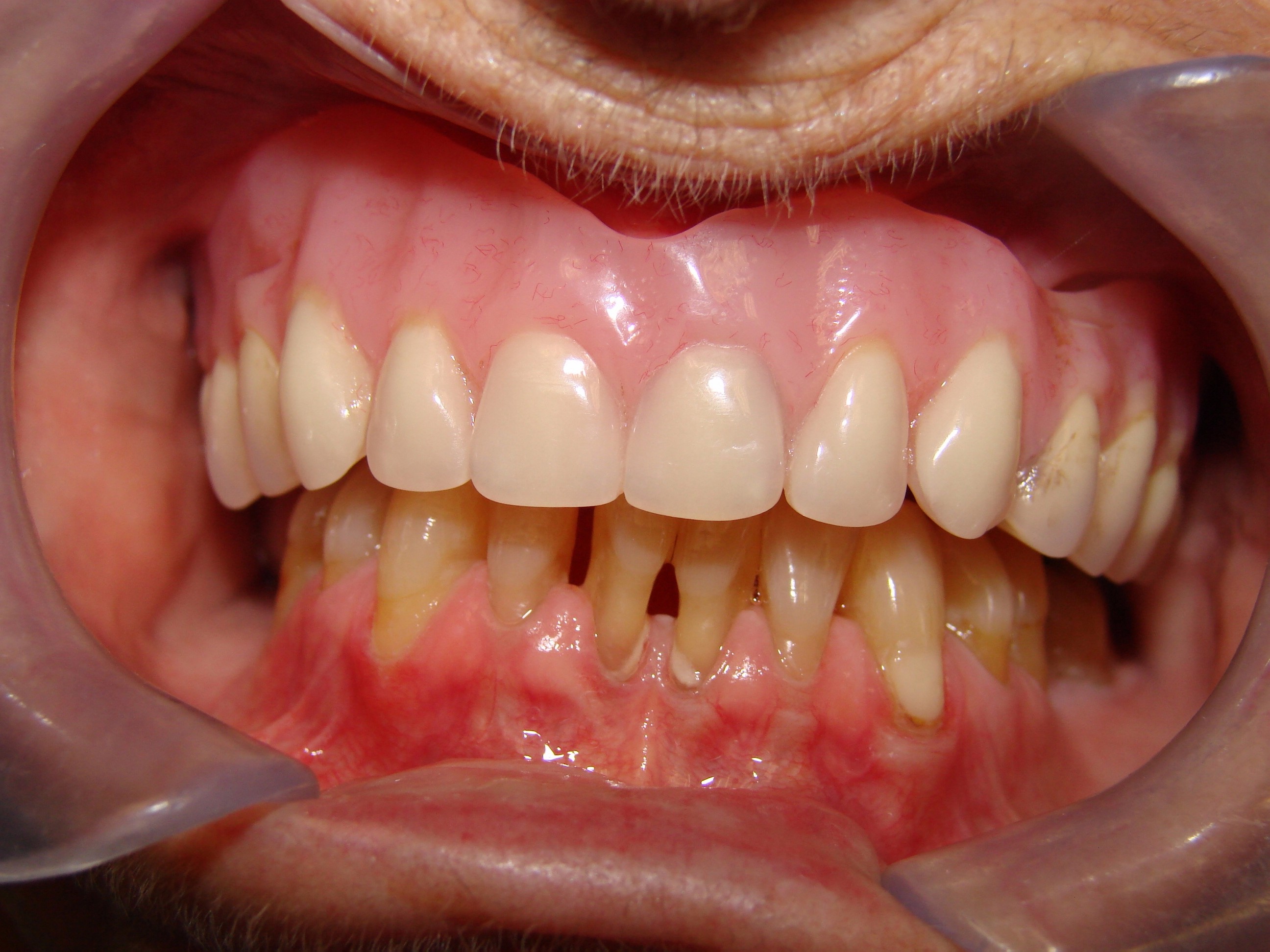 patient requiring lower dental implants in Barrie