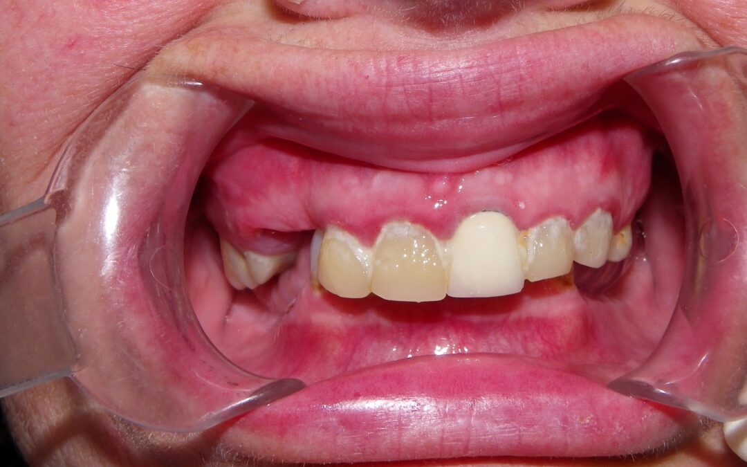 female patient requiring dental implants in Barrie