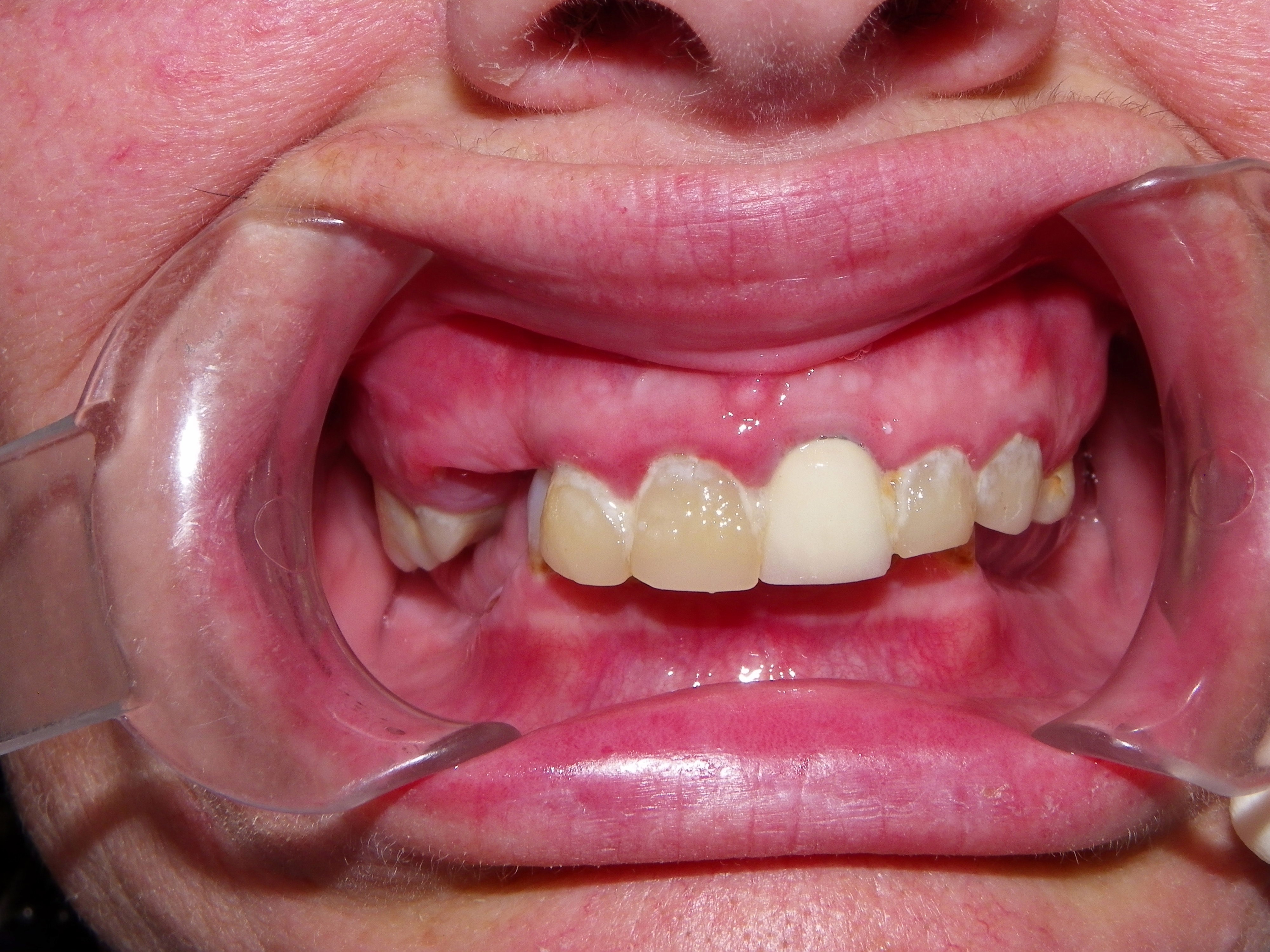 female patient requiring dental implants in Barrie