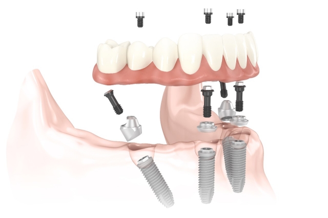 dental implant in barrie